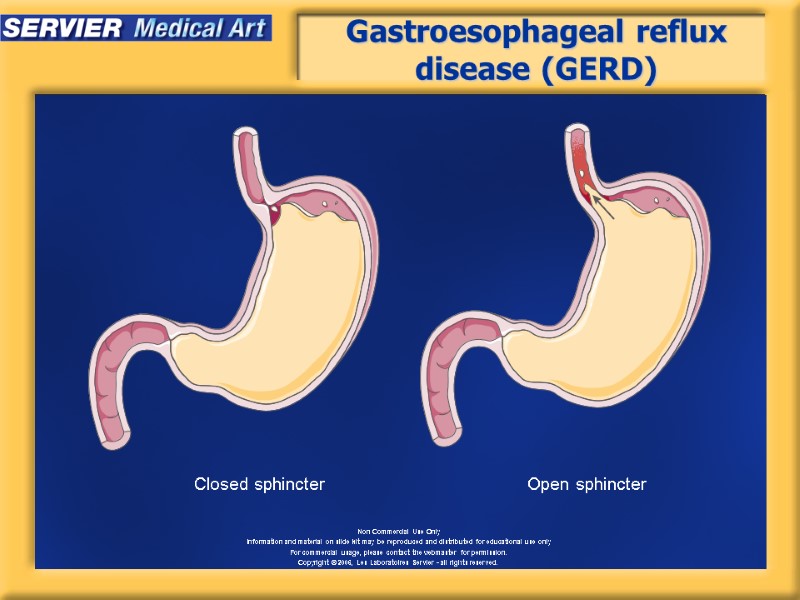 Gastroesophageal reflux disease (GERD) Closed sphincter Open sphincter